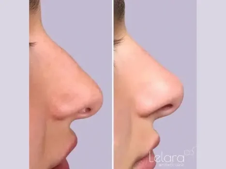 مزایا و معایب فیلر بینی