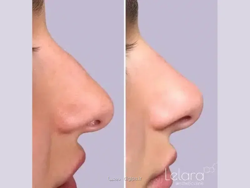 مزایا و معایب فیلر بینی